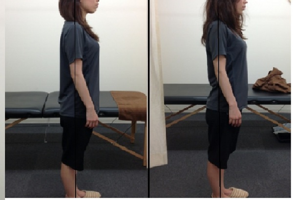 姿勢改善の事例